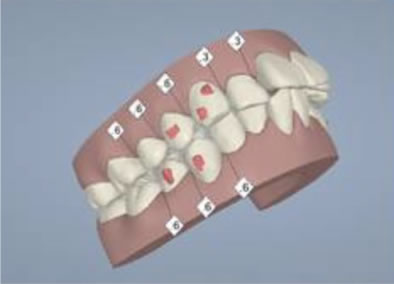 南千住小児歯科矯正歯科のクリンチェック