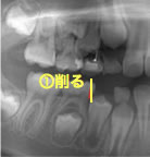 乳歯削合による永久歯萌出スペースの確保