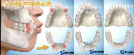 抜歯治療、上下顎左右4本抜歯
