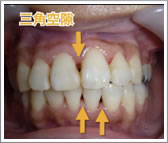 矯正治療のリスク、三角空隙