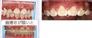 矯正治療のリスク、虫歯や歯肉炎