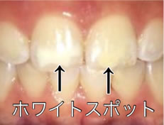 矯正治療のリスク、ホワイトスポット
