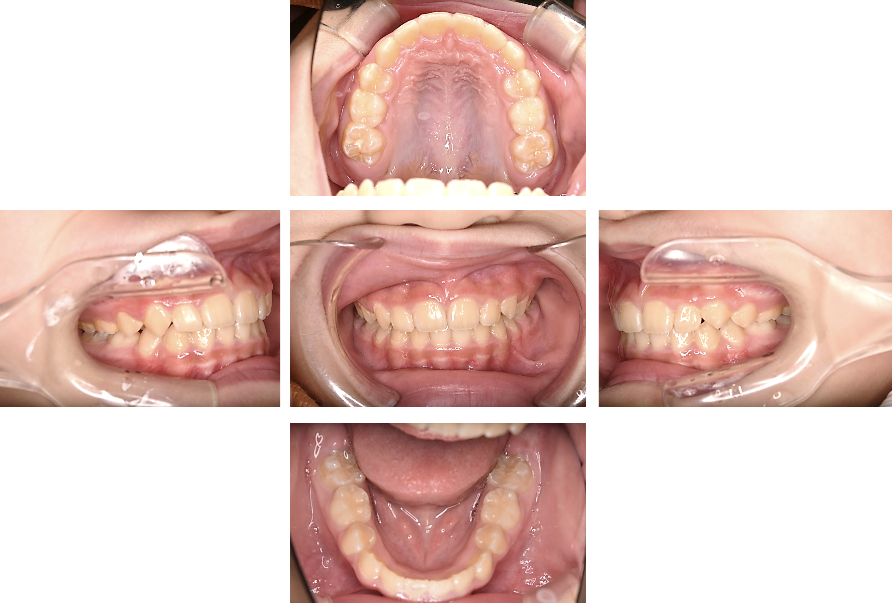 裏側矯正の症例