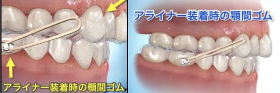 歯を移動させる為に色々な補助手段