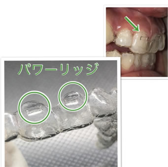 インビザラインのトラブル