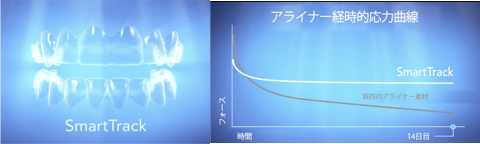 インビザラインの進化