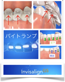 インビザライン