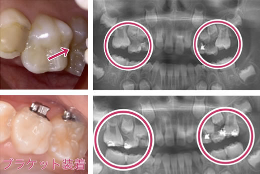 6歳臼歯を後ろに移動させ、萌出させる