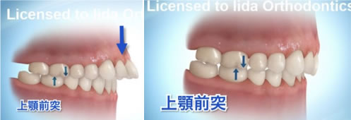 出っ歯 上顎前突 南千住の矯正歯科 南千住小児歯科矯正歯科 土日診療