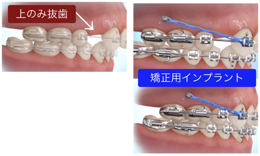 抜歯治療、上顎左右2本のみ抜歯