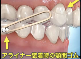 インビザライン、非抜歯治療