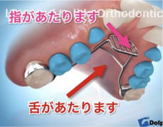 すきっ歯の矯正方法
