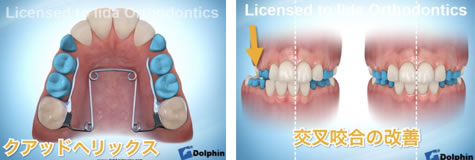 交叉咬合の治療法