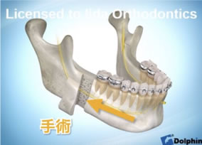 手術を併用した矯正治療