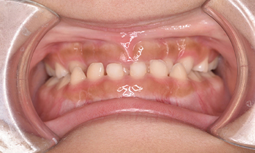 ムーシールドの症例