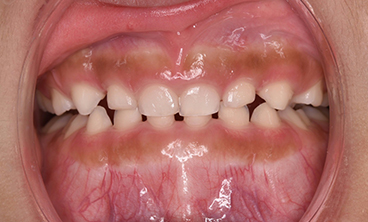 ムーシールドの症例