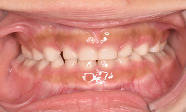 ムーシールドの症例