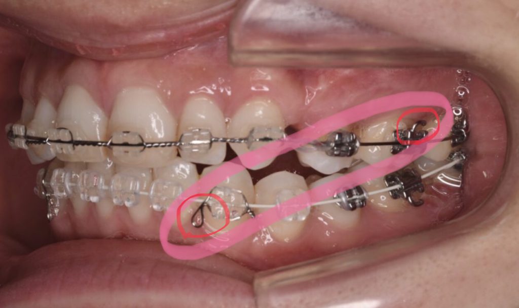 最大69％オフ！ 歯科矯正 顎間ゴム ゴムかけ 歯並び エラスティック ワイヤー インビザライン