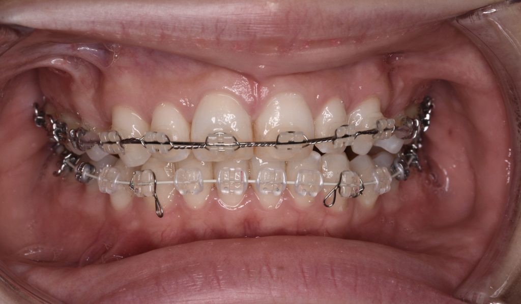 最大12%OFFクーポン 歯科矯正 顎間ゴム ゴムかけ 歯並び エラスティック ワイヤー インビザライン